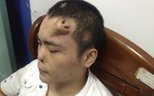 Chinese doctor builds new nose on man's forehead